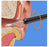Earwax Removal Kit